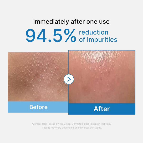 [Abo 40% Rabatt] Zero Pore Blackhead Deep Cleansing Oil